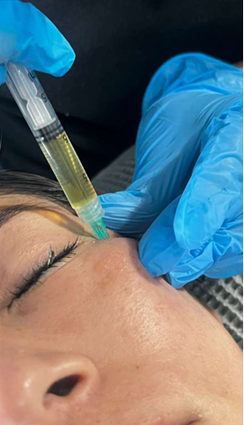 PRP Therapy (Platelet-Rich Plasma)